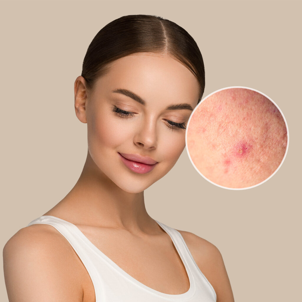 Acne blemish pimple scars